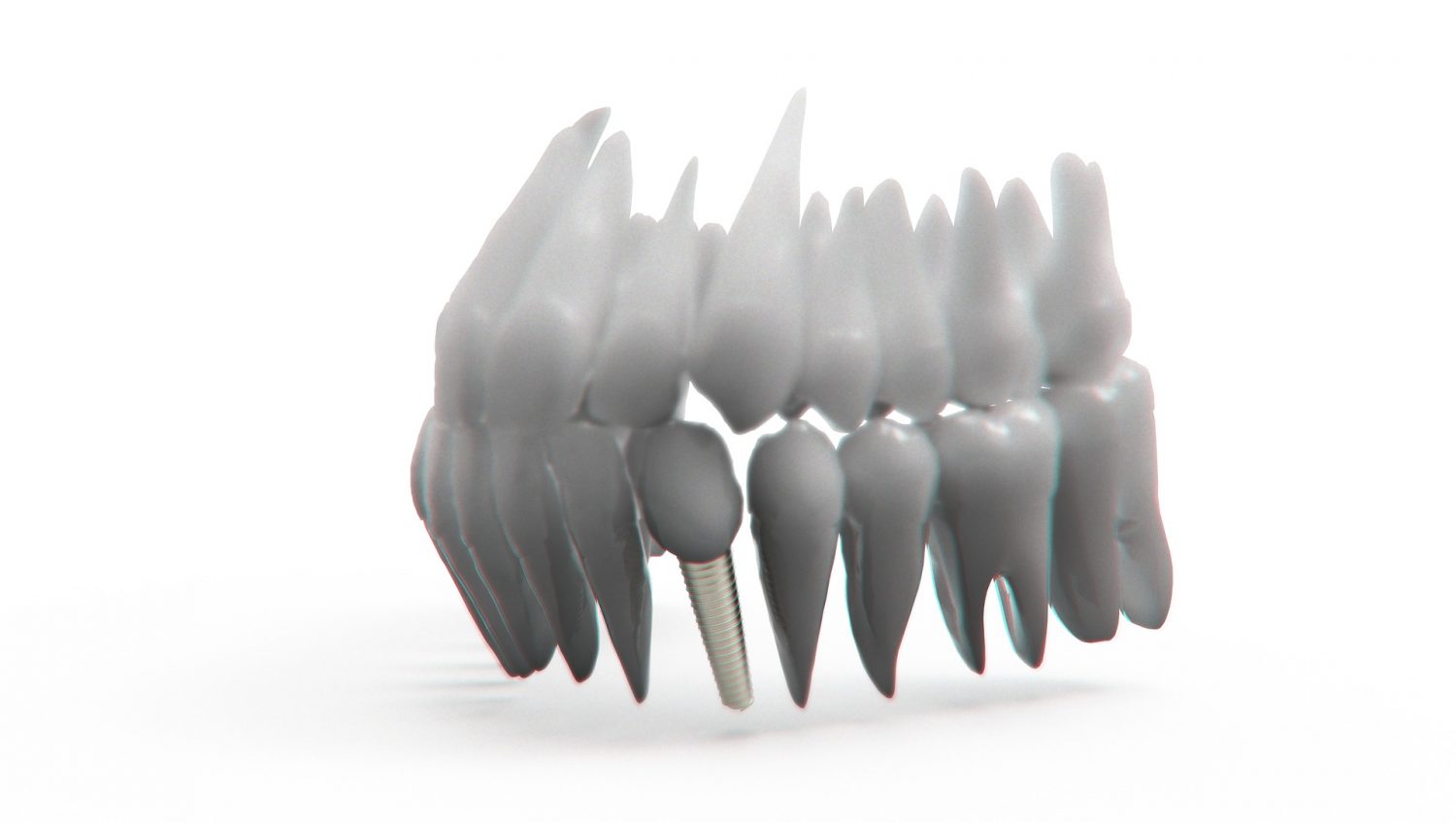 Implanty zębowe - dowiedz się więcej!